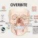 Overbite